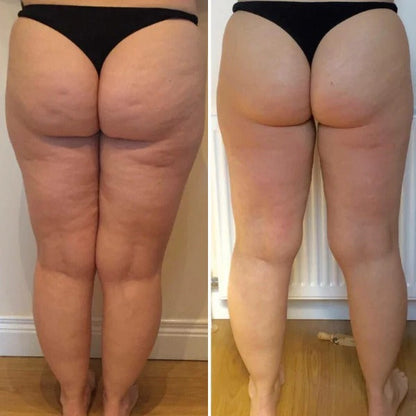Orthonod™ - Anti-Cellulite Rotating Massager