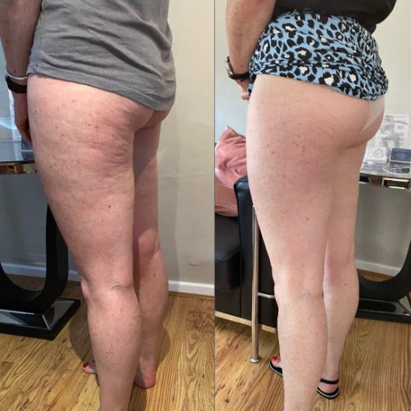 Orthonod™ - Anti-Cellulite Rotating Massager